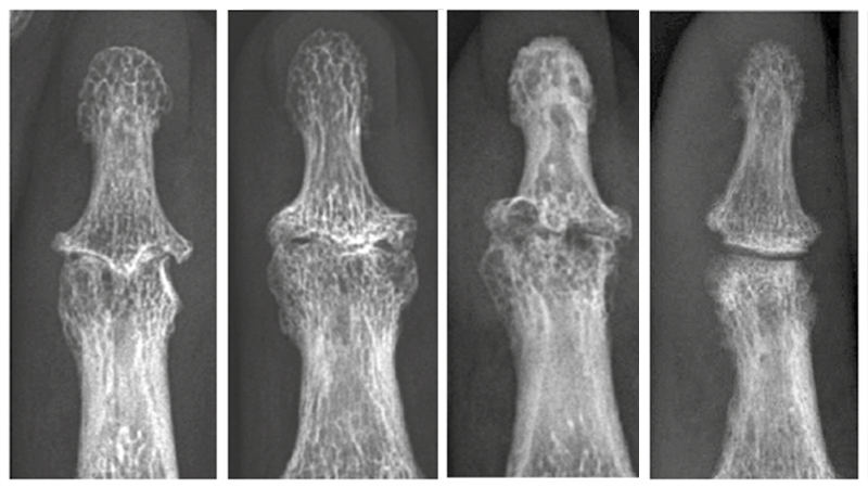 Arthropathies interphalangiennes distales analyse élémentaire Le